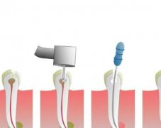 广州根管治疗多少钱?根管治疗多少天去一次?