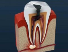 广州根管治疗价格是多少?根管治疗能够维持多久?